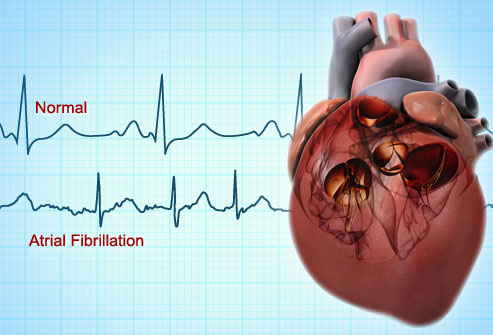 Atrial Fibrillation – Remineralize your heart